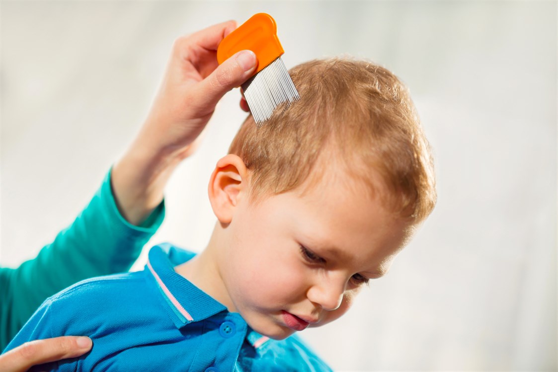 علاج قمل الرأس عند الاطفال